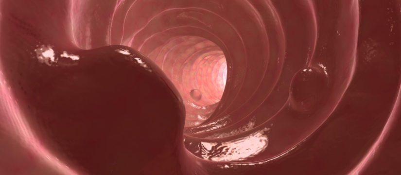 pólipos en el colon