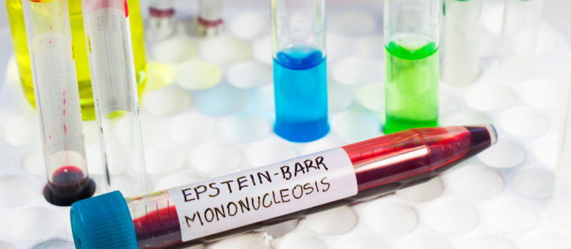 mononucleosis