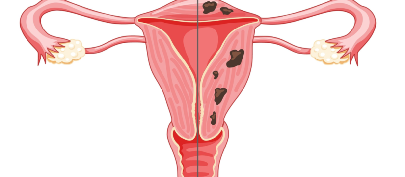 adenomiosis