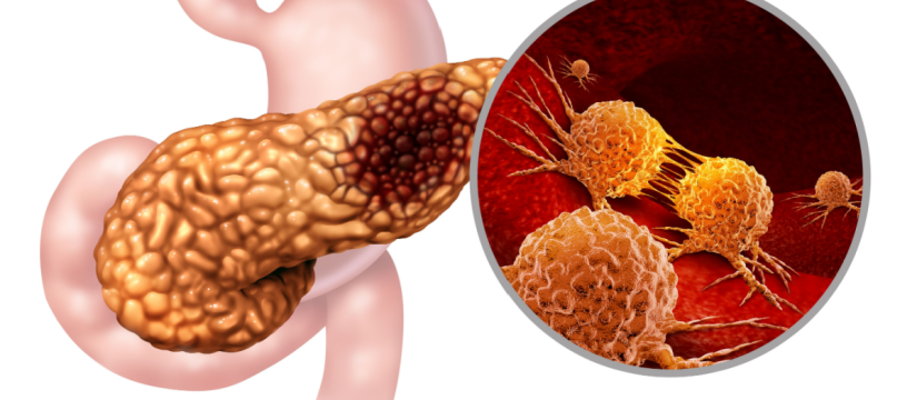 cáncer de páncreas