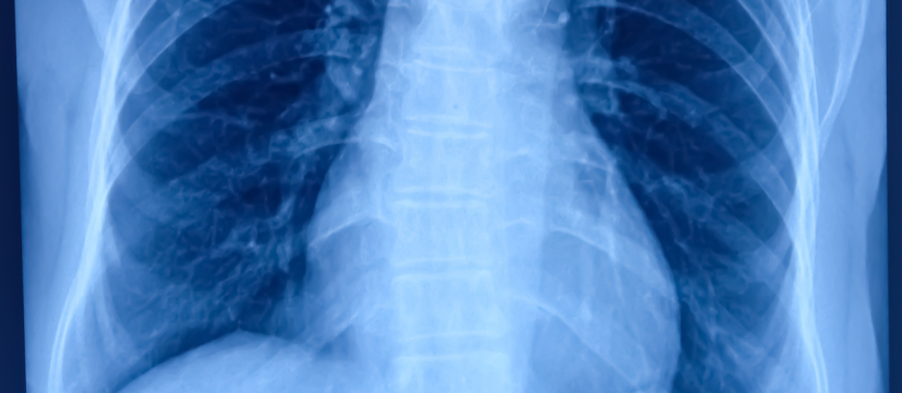 neumonitis